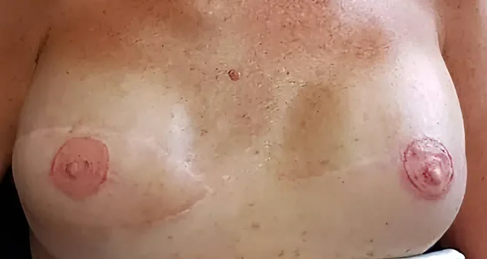 Bilateral healed areola restoration result by Lorraine — natural dimensional pigment after breast reconstruction, paramedical micropigmentation Gold Coast