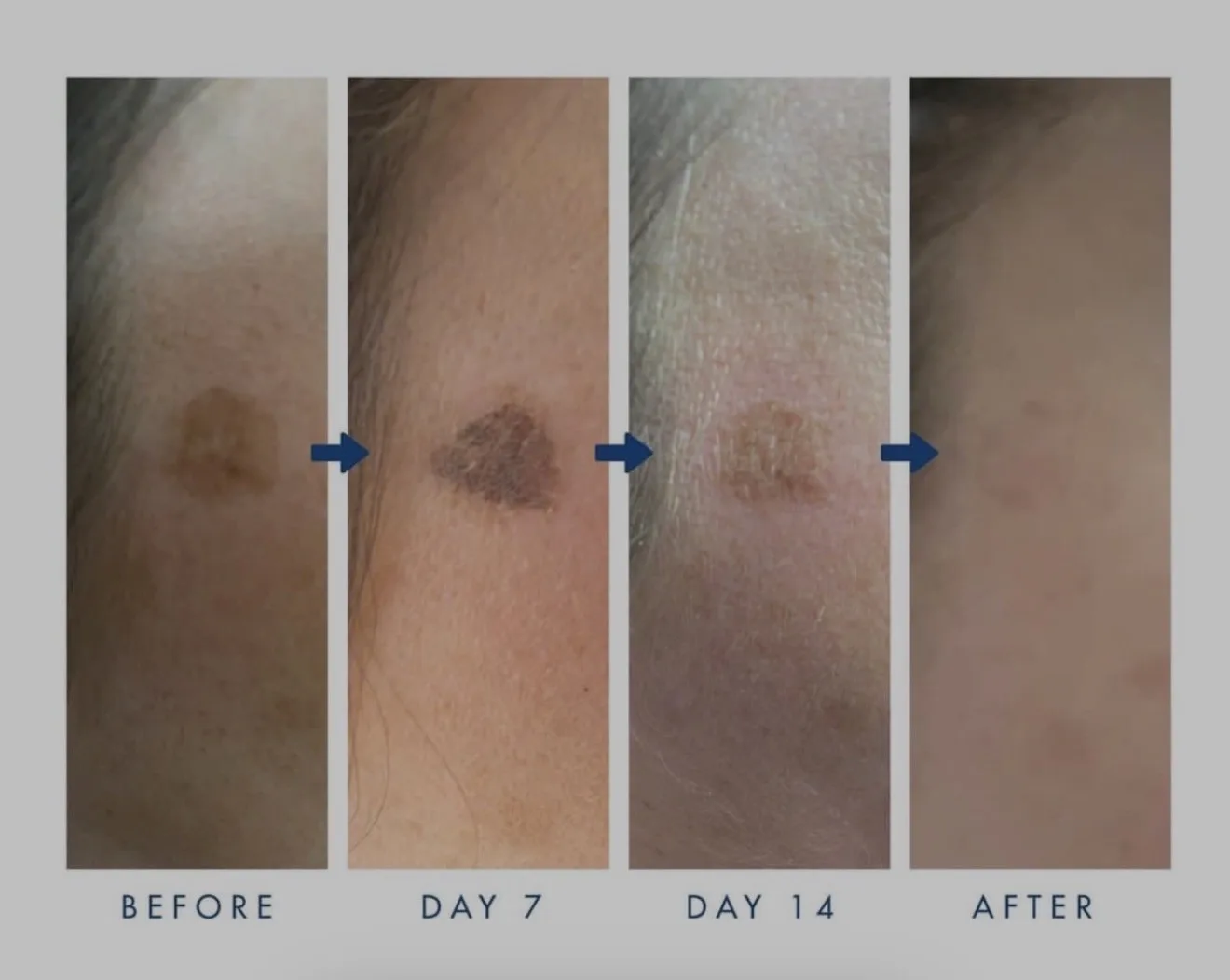 Cryotherapy lesion removal healing stages — before, day 7, day 14 and after, showing a lesion shedding to clearer skin, by Lorraine Gold Coast